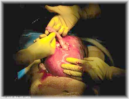 Fetal Surgery Hand